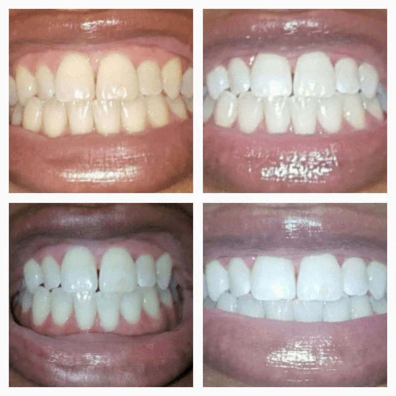 Gold Teeth Whitening Serum Pen - Image 3